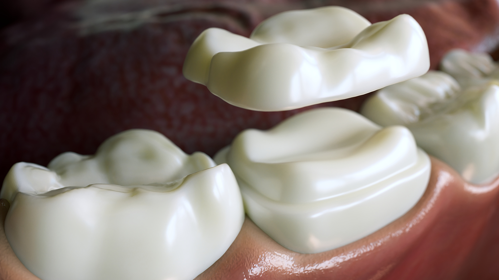 porcelain crowns