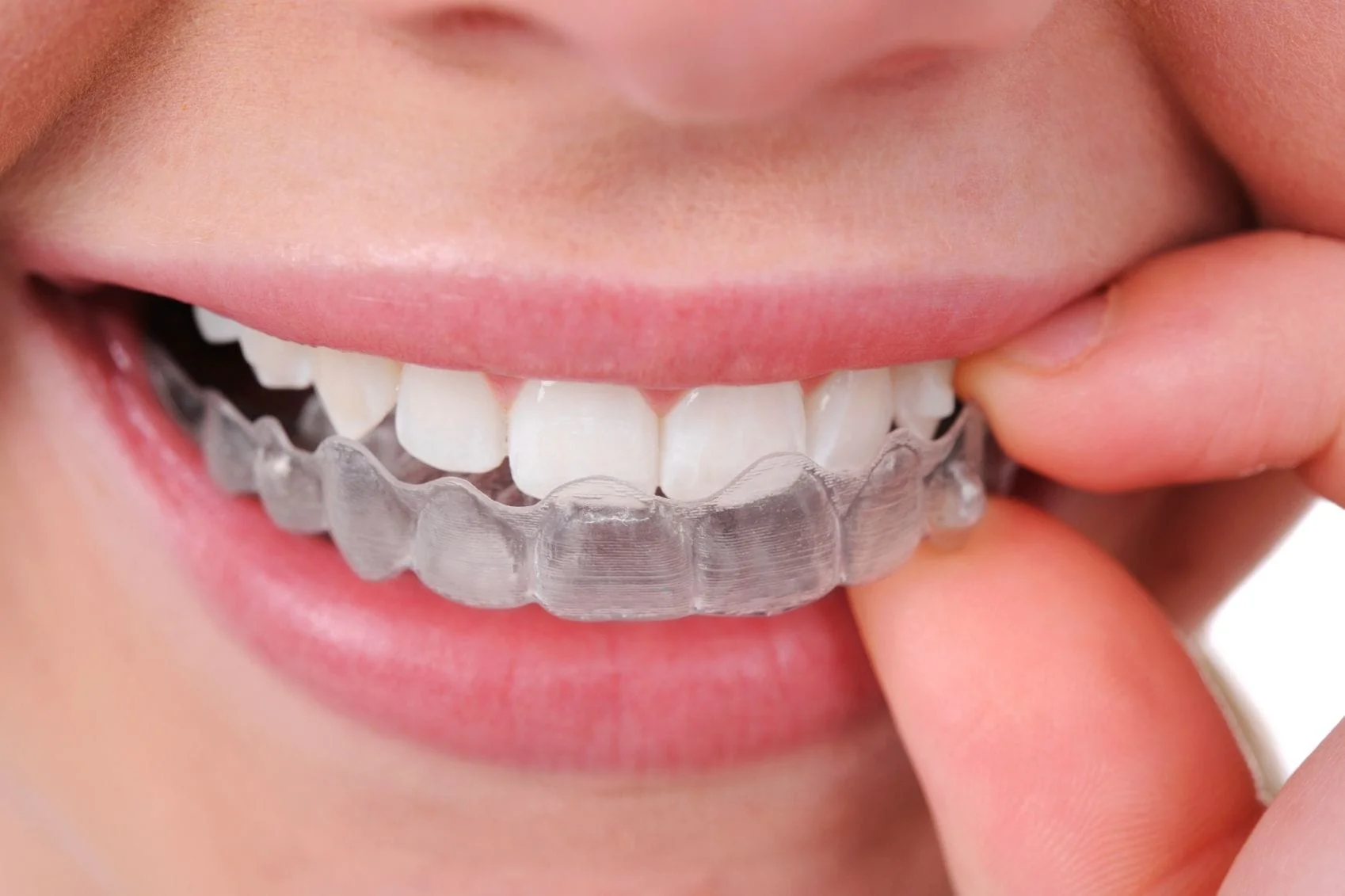 invisalign day
