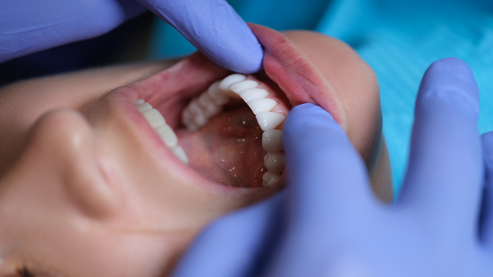 full mouth dentures