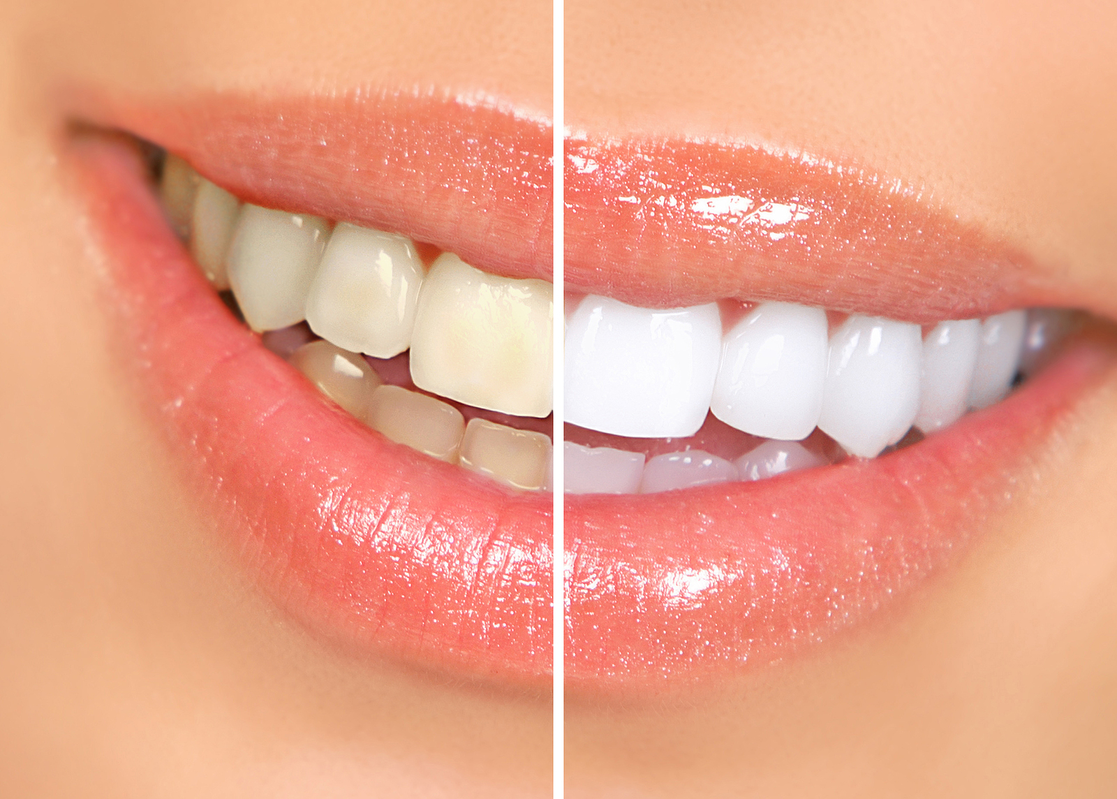 Benefits of Porcelain Veneers for Stained Teeth