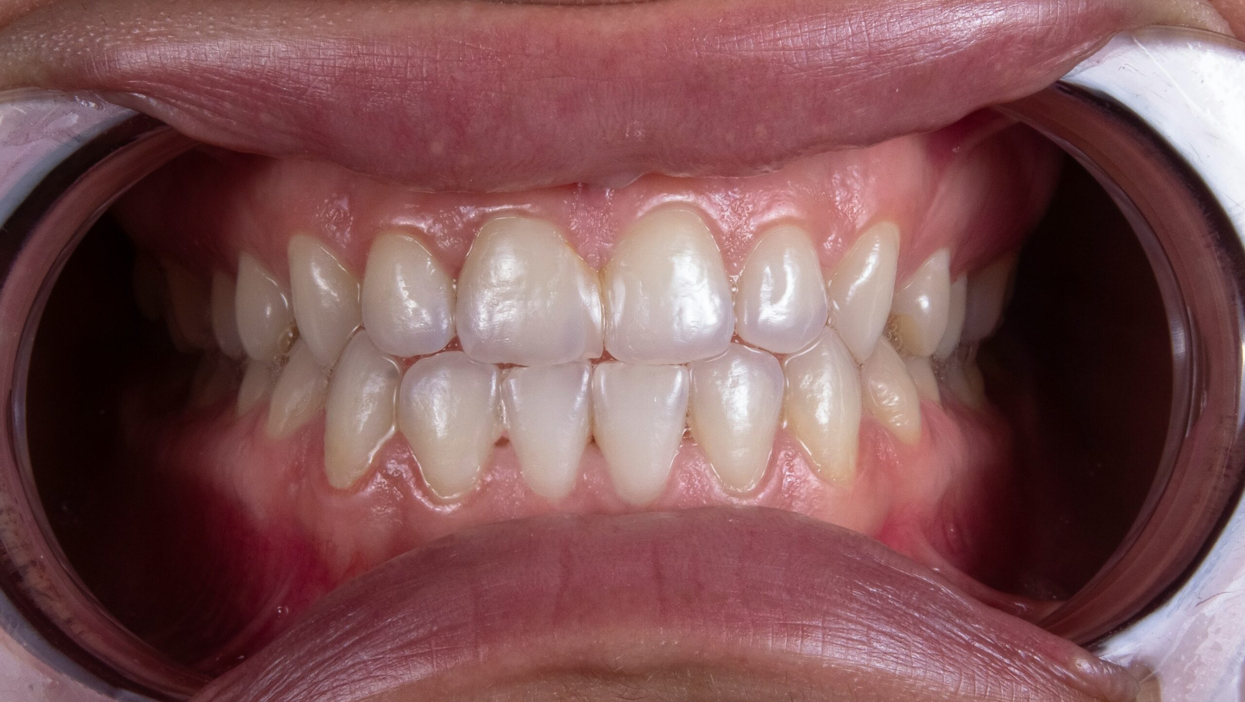 whitening vs veneers