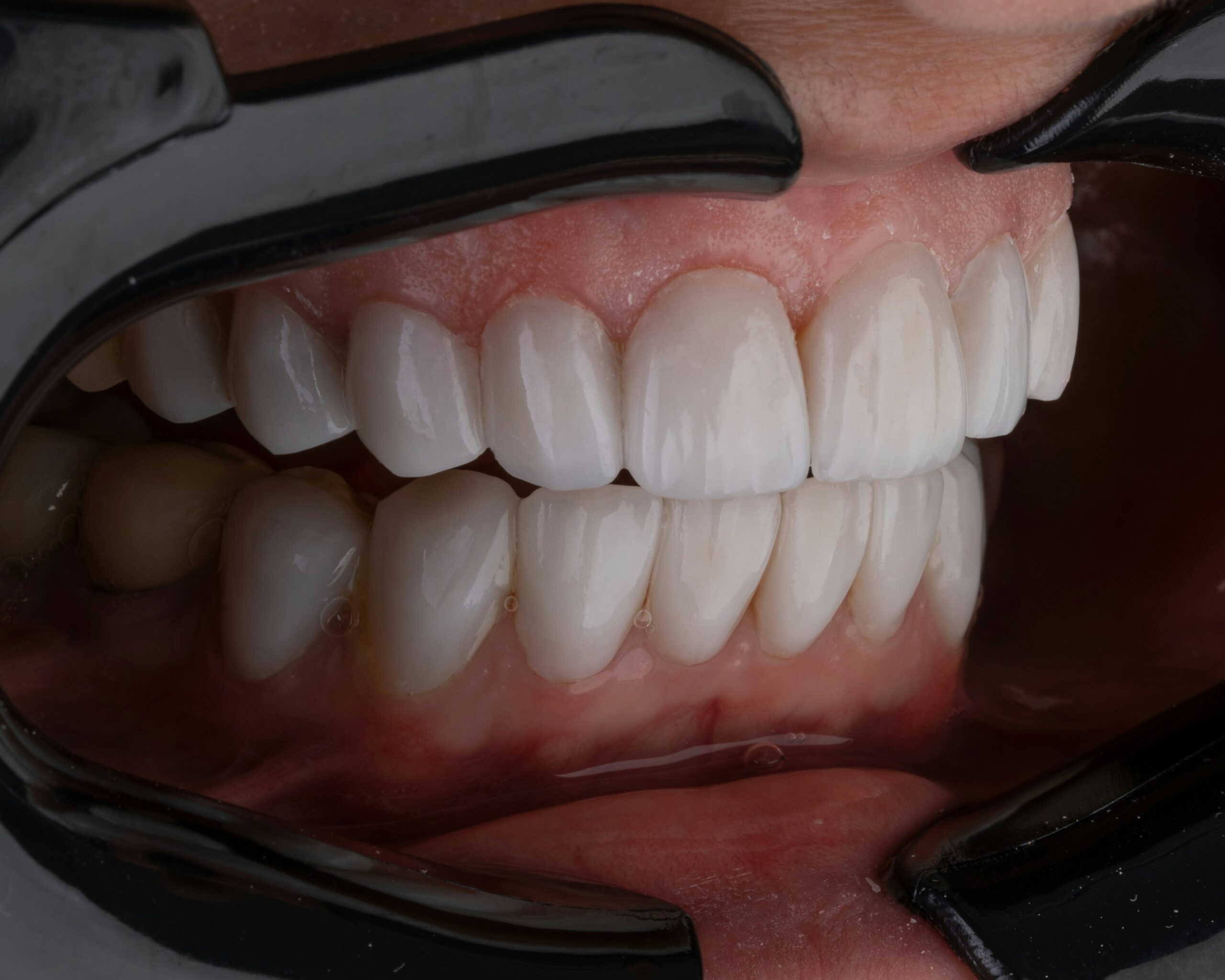 single tooth denture