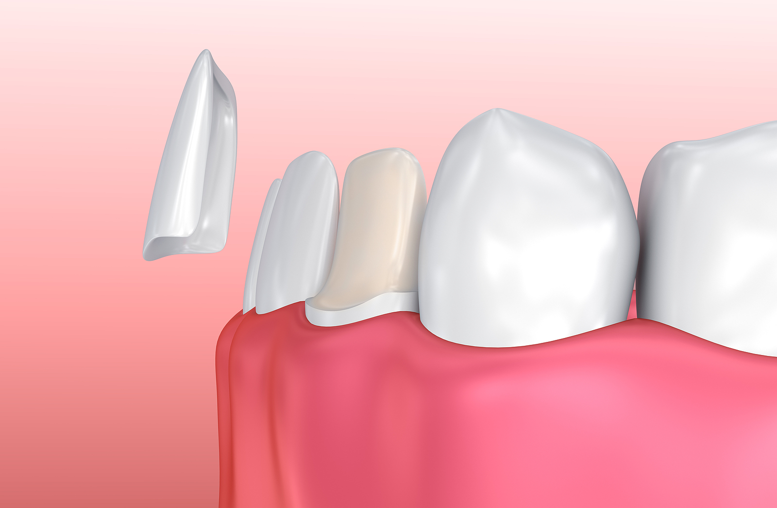 veneers benefits