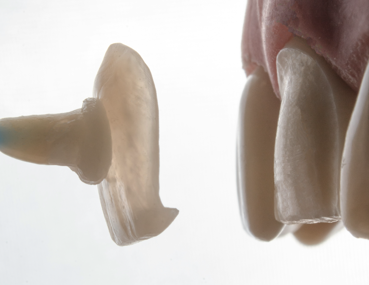 does insurance cover veneers​