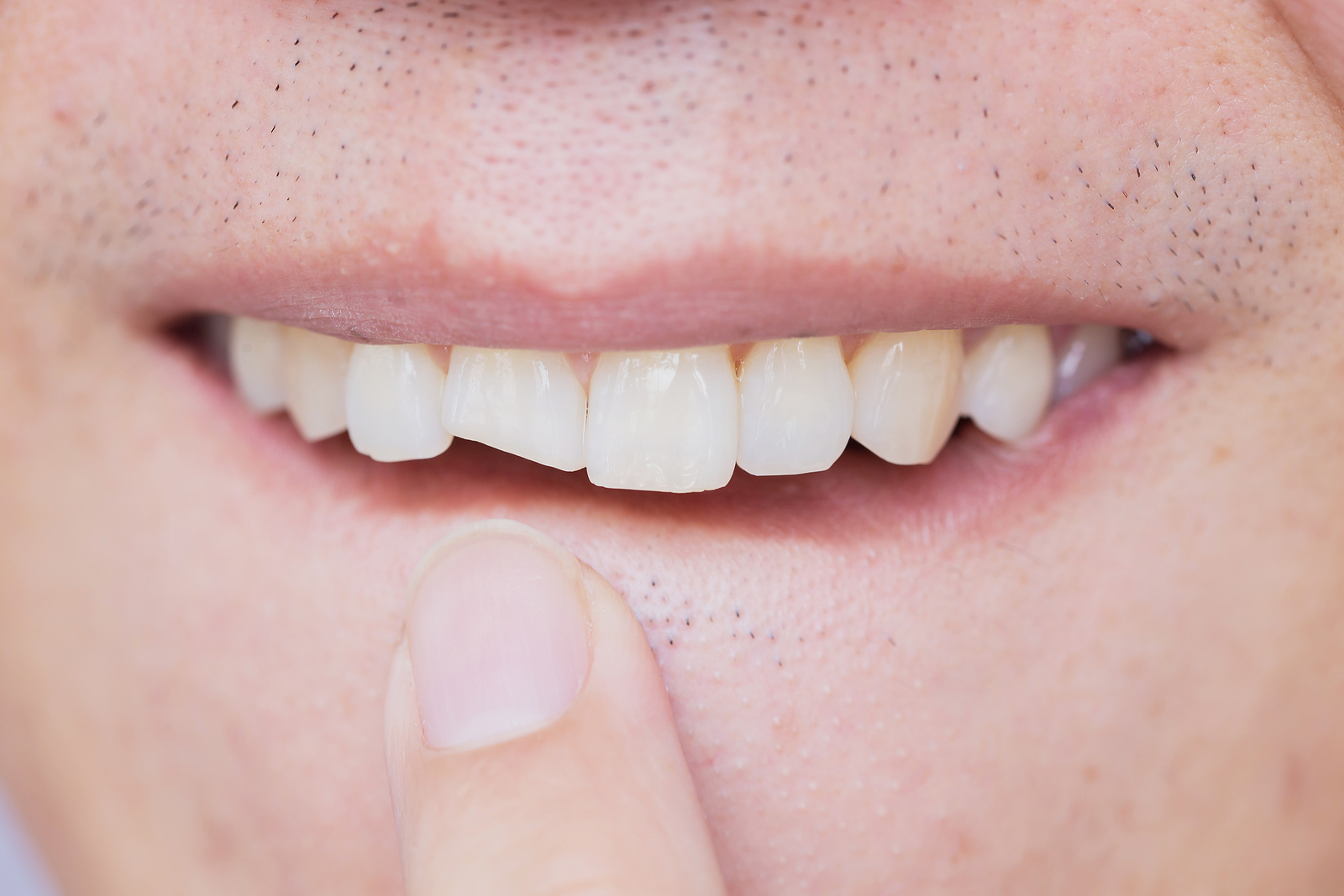 fixing a broken tooth