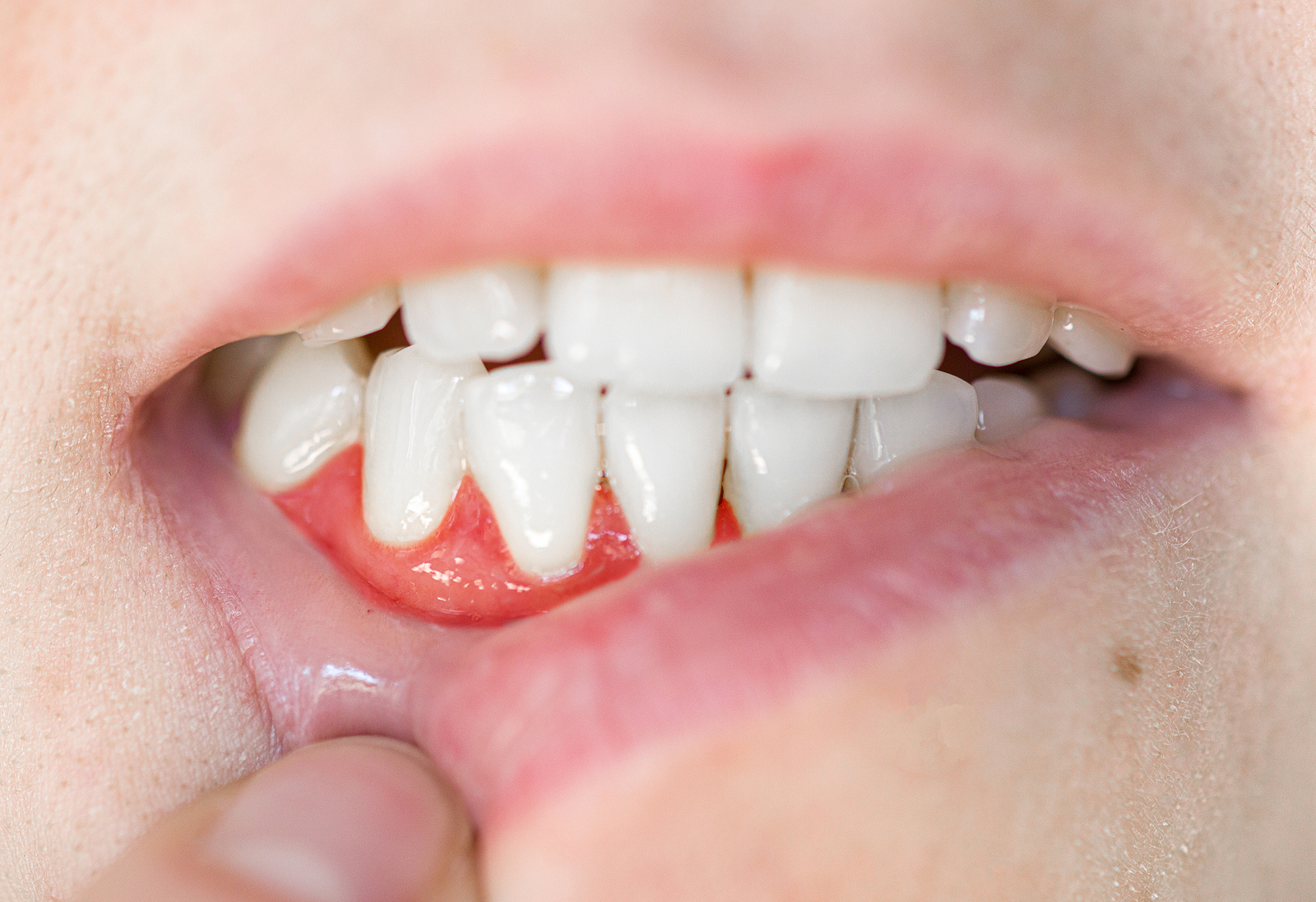 gum disease signs
