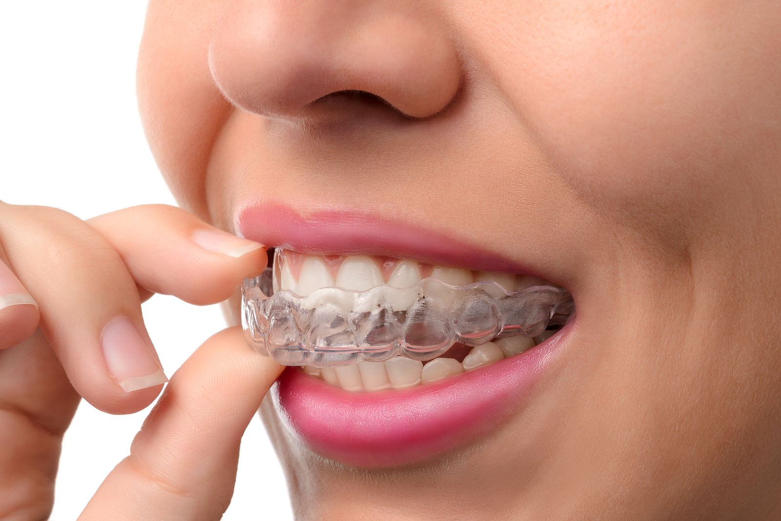 Straightening your teeth with Invisalign