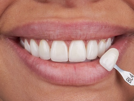 cosmetic dentistry veneers