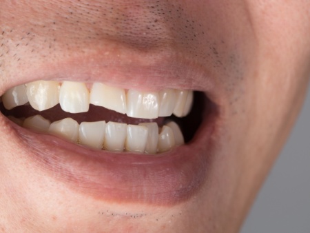 dental emergency cracked tooth