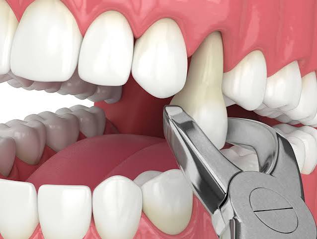 dental extractions