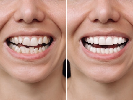 full mouth reconstruction
