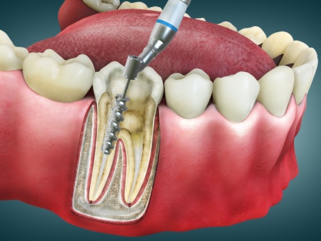 root canal
